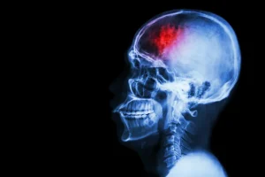 The Hidden Dangers of Mild Traumatic Brain Injuries in Auto Accidents