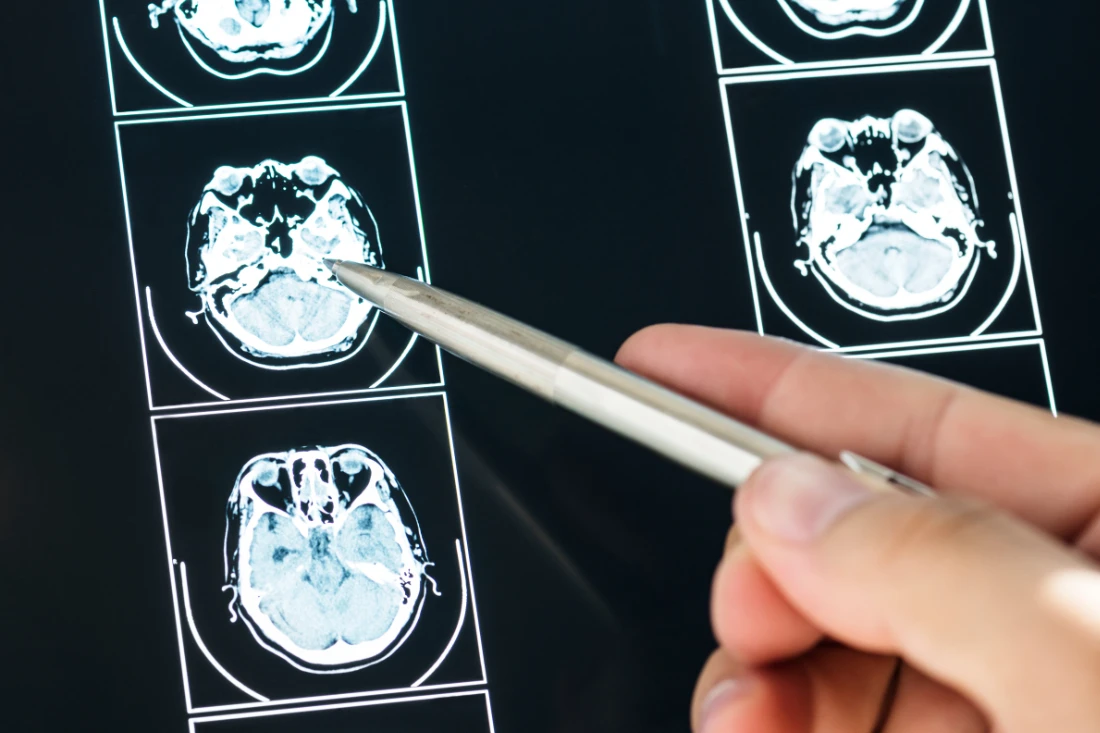 Cognitive Rehabilitation After TBI- What Insurance May Not Tell You